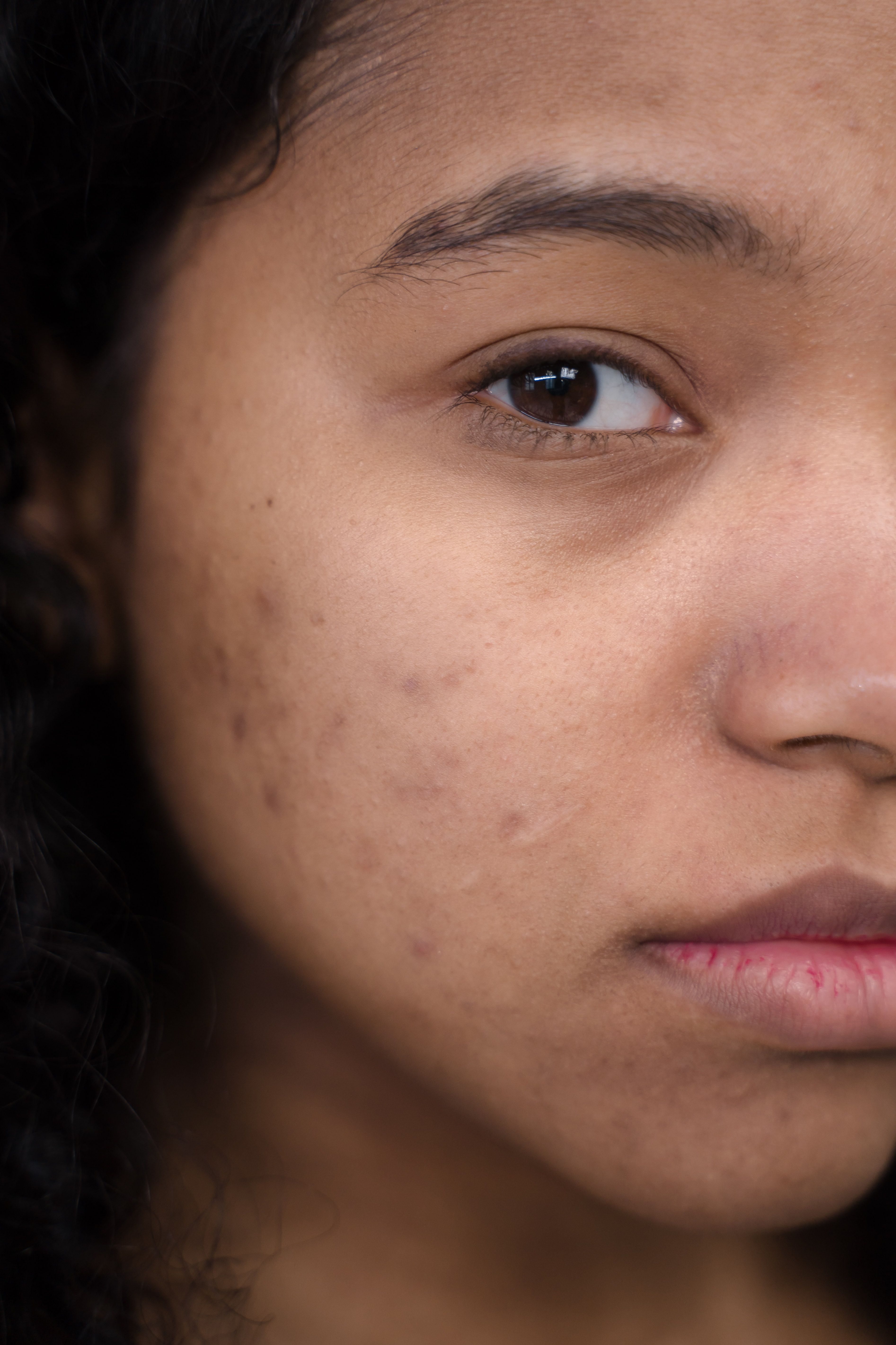 Acne Scars & Texture
